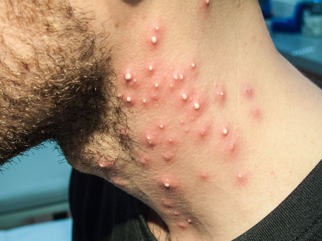 La psoriasis los síntomas cuando aparece